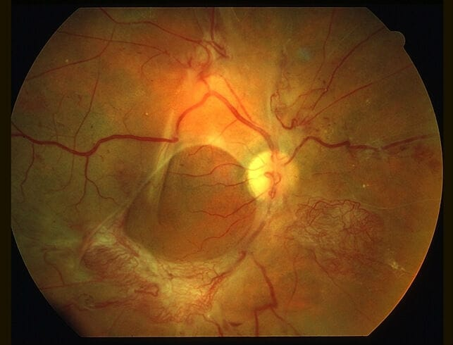 Diabetic Retinopathy – Retinal Care