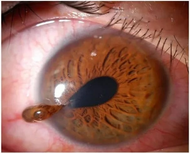 Ocular Trauma Care – Eye Injury Treatment