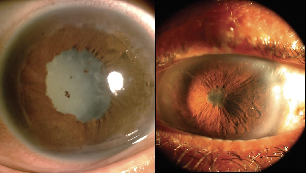 Uveitis Care – Uveitis Treatment